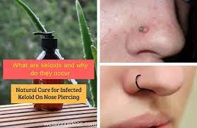 Metts says that one treatment for keloids is freezing the skin, then injecting triamcinolone, a steroid, directly into the bump 4. 10 Natural Home Remedies For Curing Infected Keloid On Nose Piercing