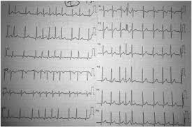 Medications to treat cardiogenic shock are given to increase your heart's pumping ability and reduce the risk of blood clots. Unexpected Guest Atrial Fibrillation Due To Electrical Shock Sciencedirect