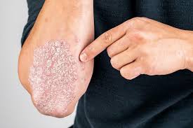 Image result for psoriasis