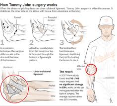 The surgical procedure is named for the iconic baseball player, then los angeles dodger tommy john. Baseball S Golden Arms On Point