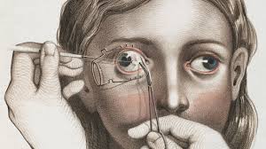 Barnett, who goes by bigo, telling the story in his own words pic.twitter.com/osykicdxgy. The Morbid History Of Victorian Surgery Beautifully Illustrated