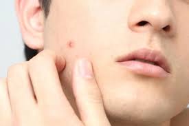 Most acne scars can go away on their own (without use of treatment) some types of acne scars require professional treatments acne scars can take 3 to 24 months to fade acne scar treatments include: How Long Does It Take For A Pimple To Go Away Skin Care Geeks