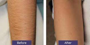 However, the total expense of laser treatment may vary depending on multiple factors. Laser Hair Removal Seattle Hair Removal Cost Seattle Plastic Surgery