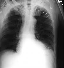 It may result from chest trauma, excess pressure on the lungs or a lung disease, such as . Chest Radiograph Shows A Left Sided Apical Pneumothorax Arrows And A Download Scientific Diagram