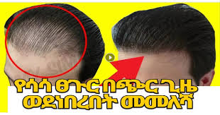 The hair line begins a horrible backward march, and more and more scalp becomes visible. Ethiofinch How To Fix Bald Hair