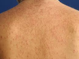 Gistpuistjes Of Folliculitis Is Geen Acne Acne Producten Acne Haarzakjes