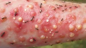 Image result for ant bite