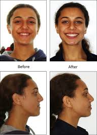 Jaw Correction Surgery