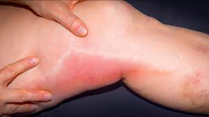 Maybe you would like to learn more about one of these? Warning Signs And Symptoms Of Blood Clot In Leg Pictures Ankle Behind Knee Images Thigh Calf Youtube