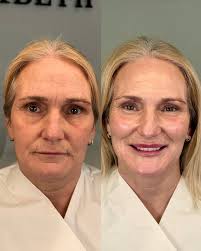 STOP SCROLLING, this is what true confidence looks like ✨ Here at Ellen  Elizabeth Aesthetics we specialise in non-surgical facelifts that leave you  with confidence that oozes & this transformation is a