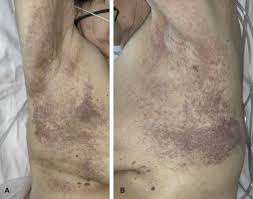 It was first identified in december 2019 in wuhan,. Reply To Covid 19 Can Present With A Rash And Be Mistaken For Dengue Petechial Rash In A Patient With Covid 19 Infection Journal Of The American Academy Of Dermatology