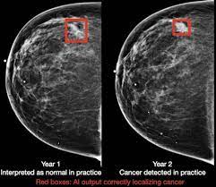 But mammograms have their limits. Can Ai Spot Breast Cancer Years Before Radiologists
