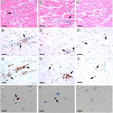 Myocarditis is most often due to infection by common viruses. Factors Associated With Myocardial Sars Cov 2 Infection Myocarditis And Cardiac Inflammation In Patients With Covid 19 Modern Pathology