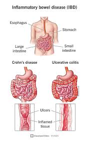 Inflammatory bowel disease IBD management
