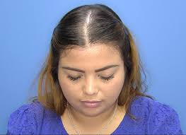 Aplicación de micropunciones con exosomas de células mesenquimales  derivadas de tejido adiposo en comparación con micropunciones en  monoterapia como tratamiento de alopecia androgenética