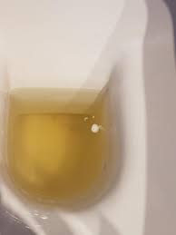 Blut Im Urin Doch Was Sind Diese Weissen Flecken Im Urin Gesundheit
