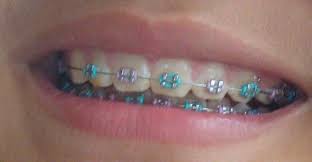 Purple And Turquoise Braces Colors Teeth Braces Dental Braces