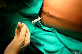 Integra Terapia Fisica A Domicilio Lumbalgia Post Puncion Una Consecuencia De La Epidural Segun Algunos Estudios La Lumbalgia Relacionada Con La Anestesia Epidural Les Ocurre A Entre Un 22 A