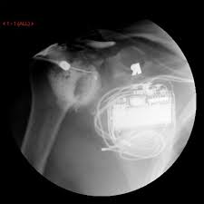 But the magnet is very powerful. Ct Arthrogram Shoulder R O Rotator Cuff Or Labral Tear Cedars Sinai