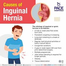 Image result for Inguinal hernia child