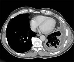 Check spelling or type a new query. Ct Scanning Not Reliable For Correct Diagnosis Of Pleural Mesothelioma