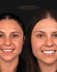 They're called the “social six” — your top front teeth, the first thin...