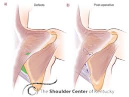 There are other muscles that pull the shoulder blade out of the ideal alignment. Scapula Muscle Detachment Shoulderdoc