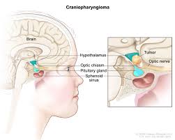 Brain tumour symptoms can be very similar to those of childhood illnesses. Childhood Craniopharyngioma Treatment Pdq Patient Version National Cancer Institute