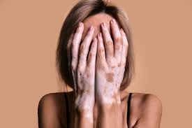 Image result for Vitiligo