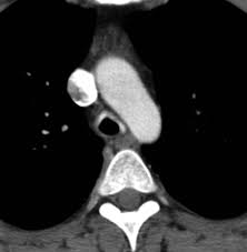 Image result for Relapsing Polychondritis