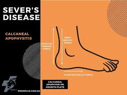 Image result for Calcaneal Apophysitis