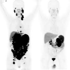 Death from prostate cancer most often happens when cancer has spread (metastasized) to other organs in the body. Hope For Metastatic Prostate Cancer Patients Targeted Alpha Therapy Shows Impressive Results Eu Science Hub