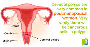 Bleeding after menopause does not always mean cancer growth bleeding after menopause may happen to some women. What Are Some Of The Causes Of Bleeding After Menopause Quora