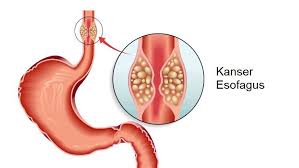 We did not find results for: Berak Berdarah Punca Dan Rawatan The Diagnosa