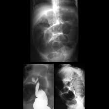 Image result for Sigmoid Volvulus