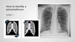 Deviation of the trachea away from the side of the tension, a shift of the mediastinum and depression of the hemidiaphragm. How To Identify Pneumothorax On A Chest X Ray Youtube