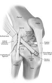 Fibular collateral ligament (fcl) injuries can lead to varus instability of the knee, causing a varus thrust gait. Ellison Technique 31 Acl Anterior Cruciate Ligament Fcl Fibular Download Scientific Diagram