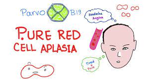 It is usually a symptom of another underlying disorder, but can be congenital or ideopathic. Pure Red Cell Aplasia Youtube