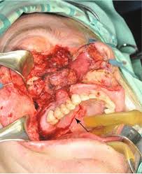 Maybe you would like to learn more about one of these? Open Surgical Approaches To The Paranasal Sinuses Plastic Surgery Key