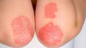 Image result for psoriasis