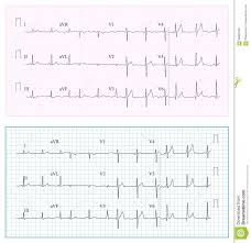 Heart Cardiogram Chart Vector Set Healthy Heart Rhythm