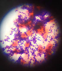 Image result for Staphylococcus Saprophyticus