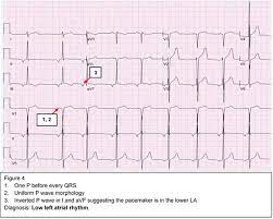 Slow rising pulse, an ejection systolic murmur heard loudest in the aortic area which radiates to the carotids. Pediatric Cardiology