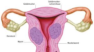 Kadın pelvisinde (havsala, leğen kemiği bölgesi, kasık) görülen en sık büyüme tipidir. Gesundheitslexikon Myom
