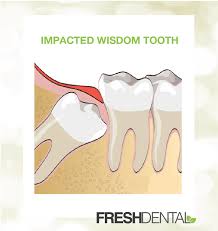 Read more about how a wisdom tooth is removed and recovering from wisdom tooth removal. Wisdom Teeth Removal Fresh Dental Nc Your Local Dentist