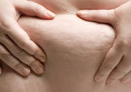 Can sweating get rid of cellulite? Can You Get Rid Of Cellulite On The Thighs