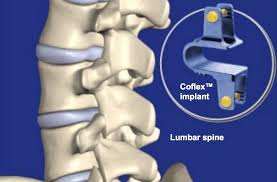 Coflex Surgery Recovery Spine Surgeons Florida Surgery Consultants