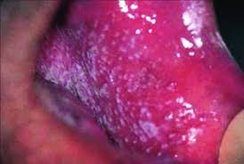 Image result for lichen planus on tongue)