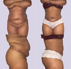 Zekerheid Bij Liposuctie En Liposculptuur Parkkliniek Rotterdam