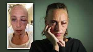 Gofundme raises money for Dapto mum blinded in alleged Kembla Grange  playground attack, Carissa Edwards